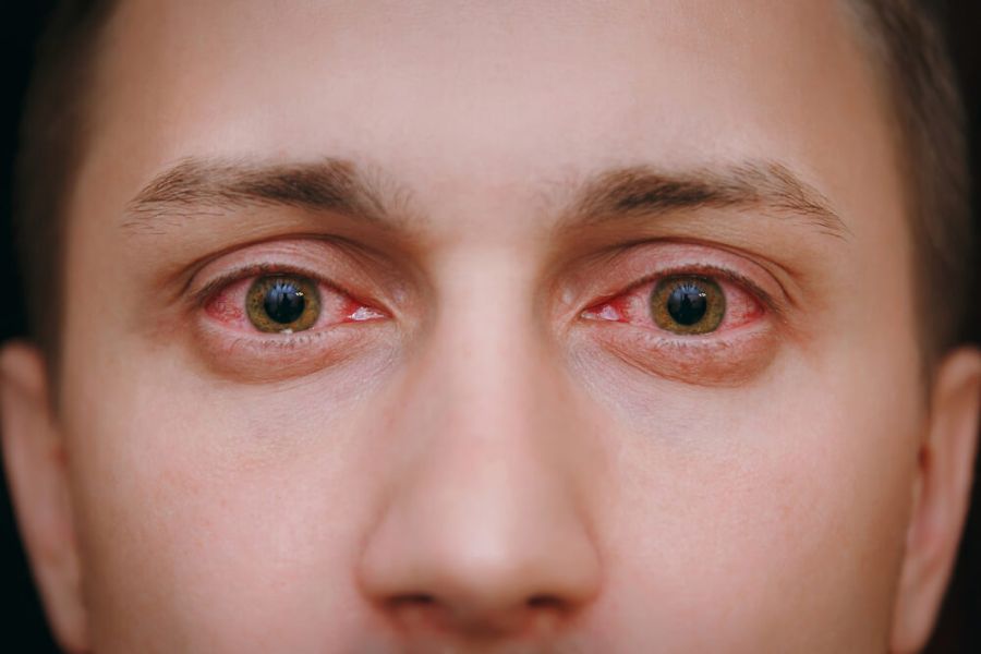 Simptomi alergijske reakcije na polen - Suzne oči